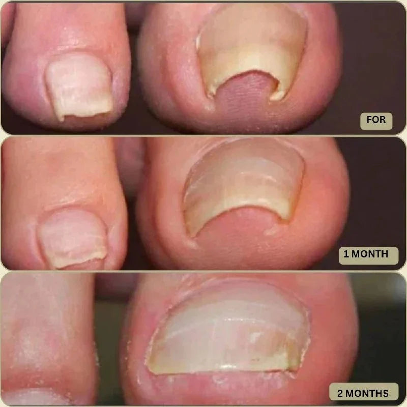 Adhesive Nail Support Strips Low-Profile Gentle Adhesive & Easy Apply