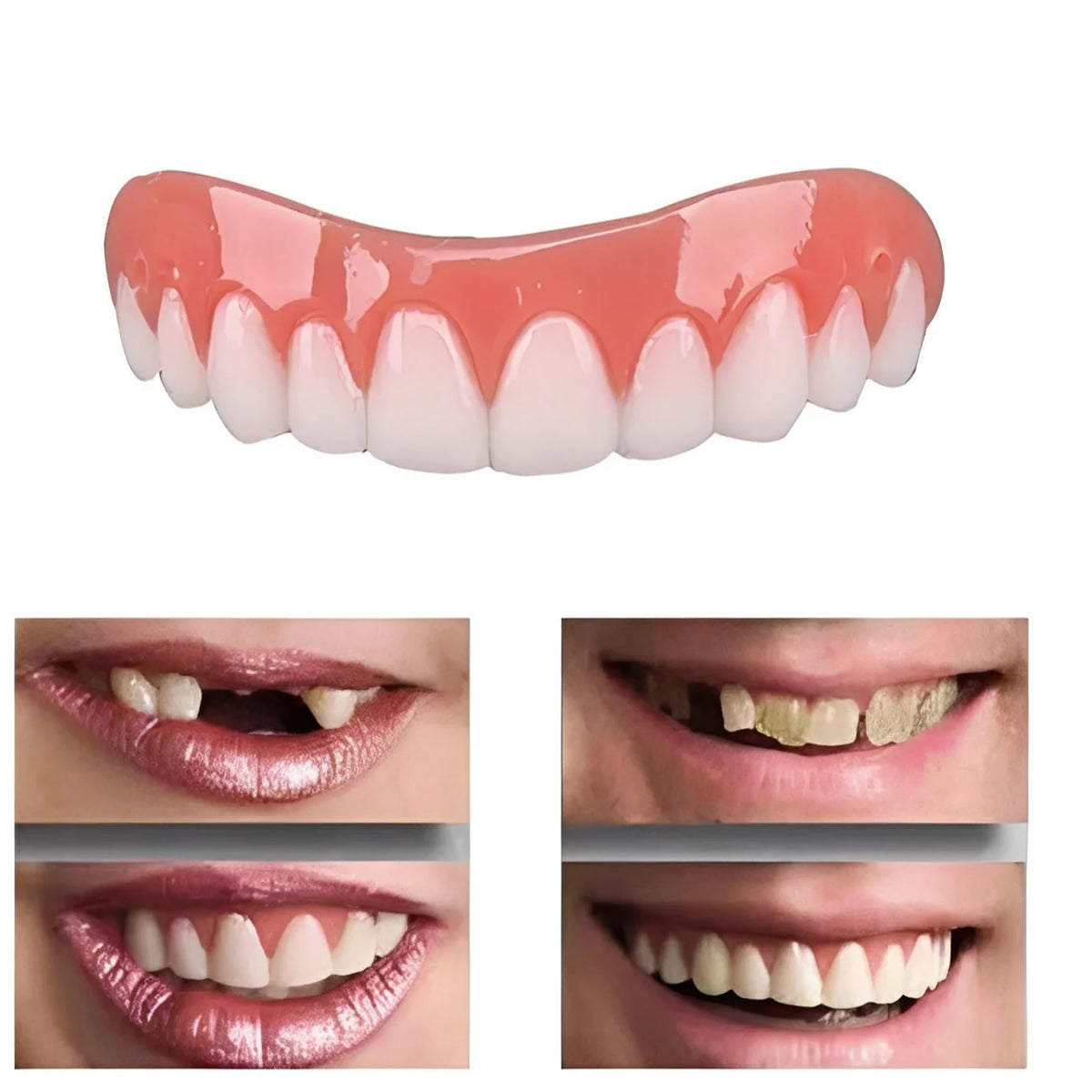 Temporary Tooth Veneer Hot-Water Moldable Reusable & Adhesive-Free