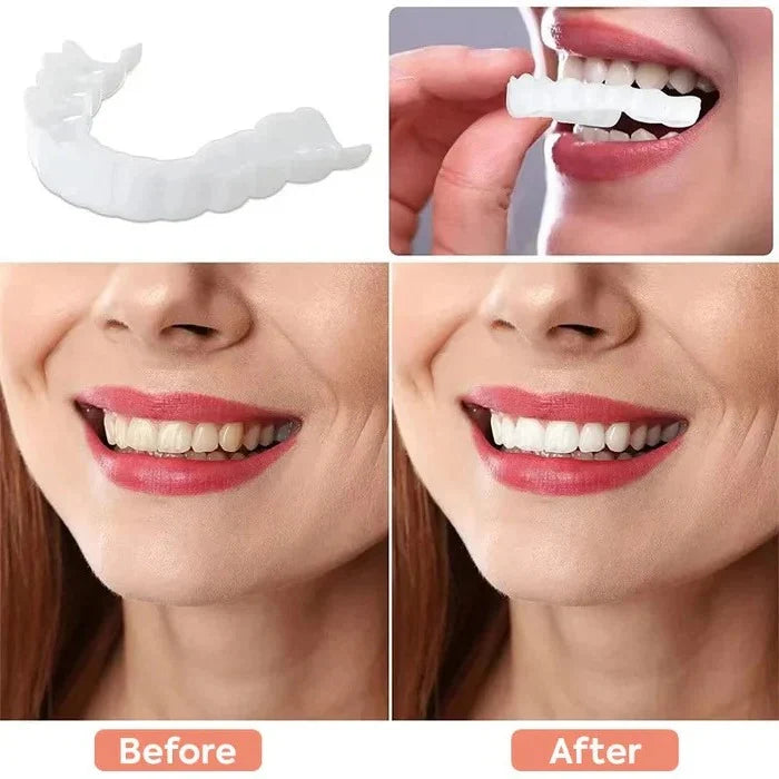 Temporary Veneers Clip-On Reusable Universal Fit
